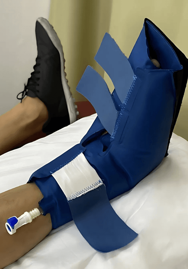 Cryotherapy Treatment